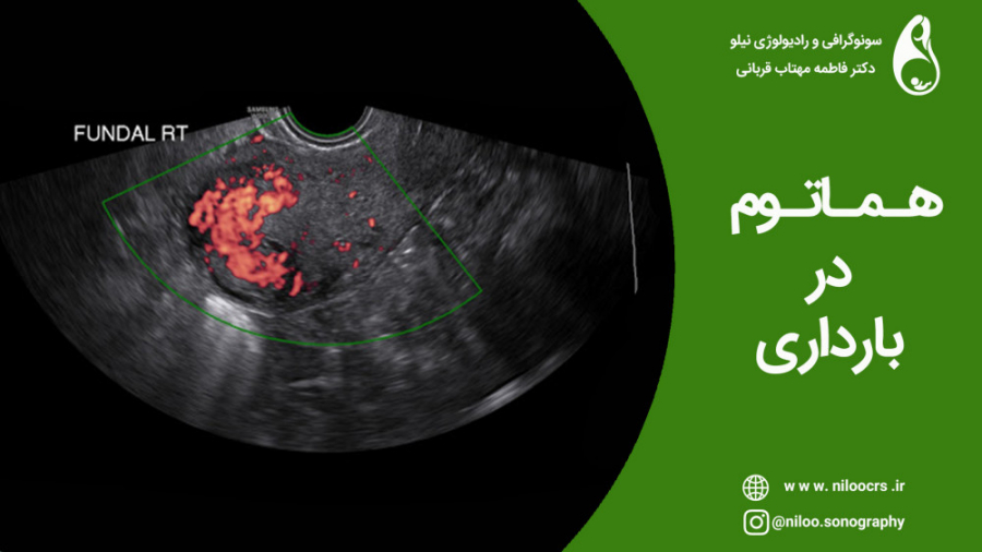 هماتوم بارداری سونوگرافی نیلو دکتر فاطمه مهتاب قربانی