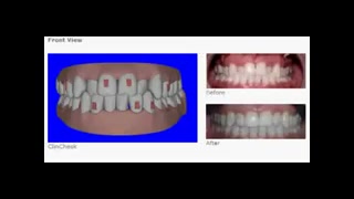 کراس بایت (cross bite) دکتر سهیل سالاری