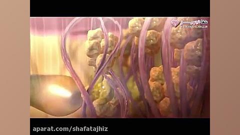 لاغری فرم دهی و زاویه سازی صورت و بدن با دستگاه آمریکایی bodytite facetite ترمیم لبخند لثه‌ای