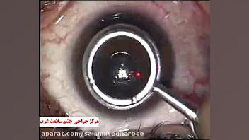 عمل جراحی چشم به روش PRK کلونینگ درمانی