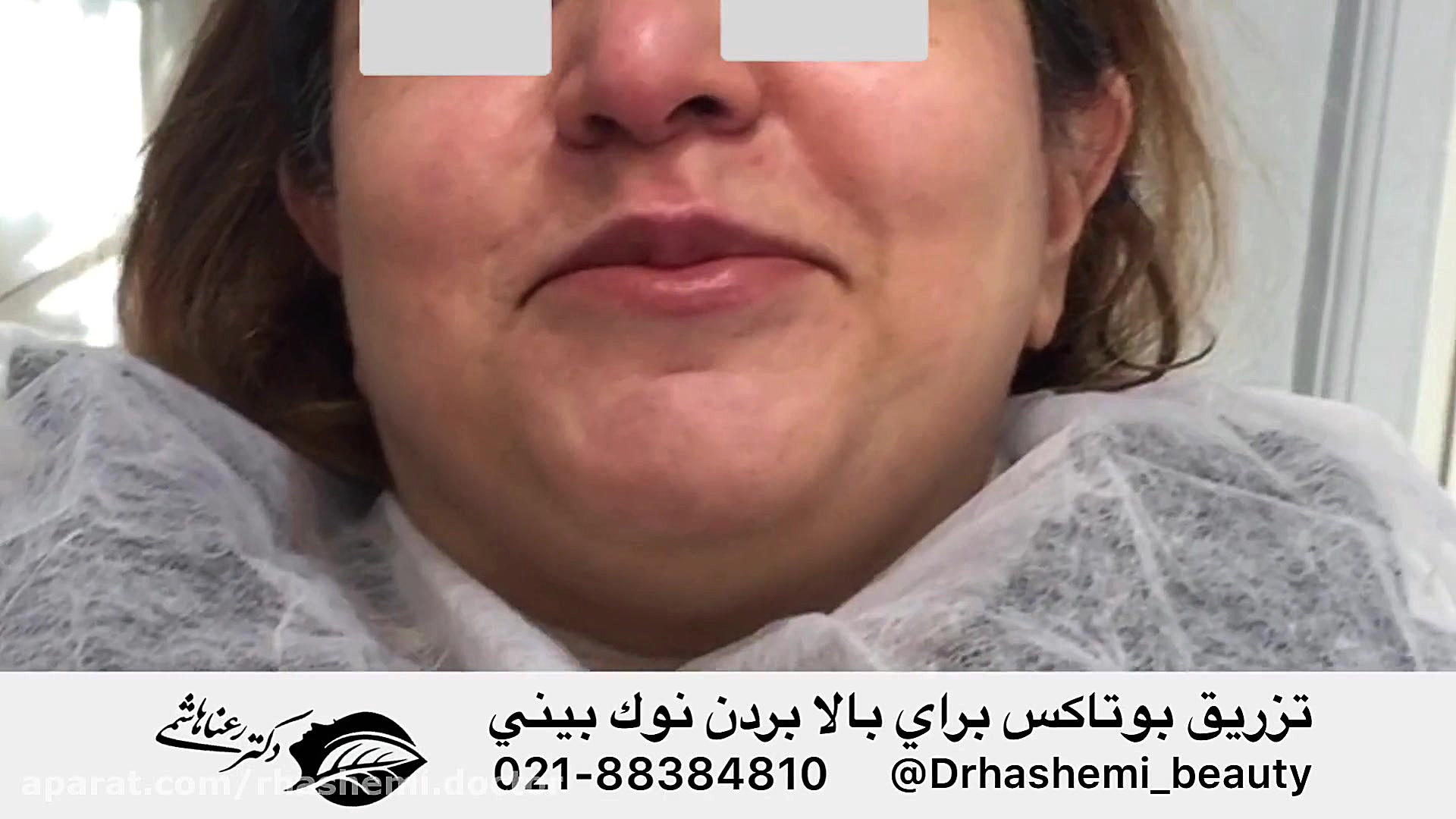 تزریق بوتاکس به بینی تست انعقاد PT/PTT