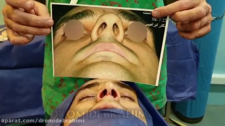 جراحی انحراف بینی استخوانی توسط دکتر امید ابراهیمی بهترین جراح بینی دکتر امید ابراهیمی
