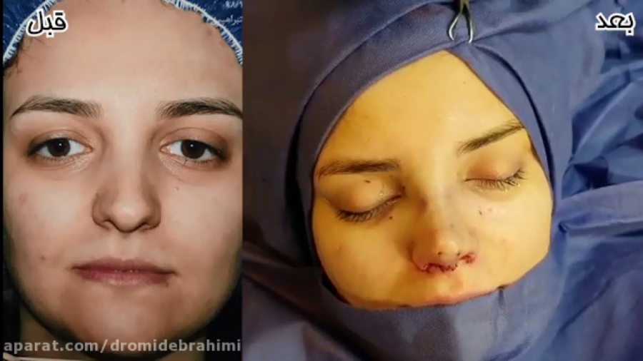 جراحی بینی نیمه فانتزی توسط دکتر امید ابراهیمی بهترین جراح بینی دکتر امید ابراهیمی