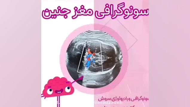 فیلم سونوگرافی مغز جنین پریودنتیکس