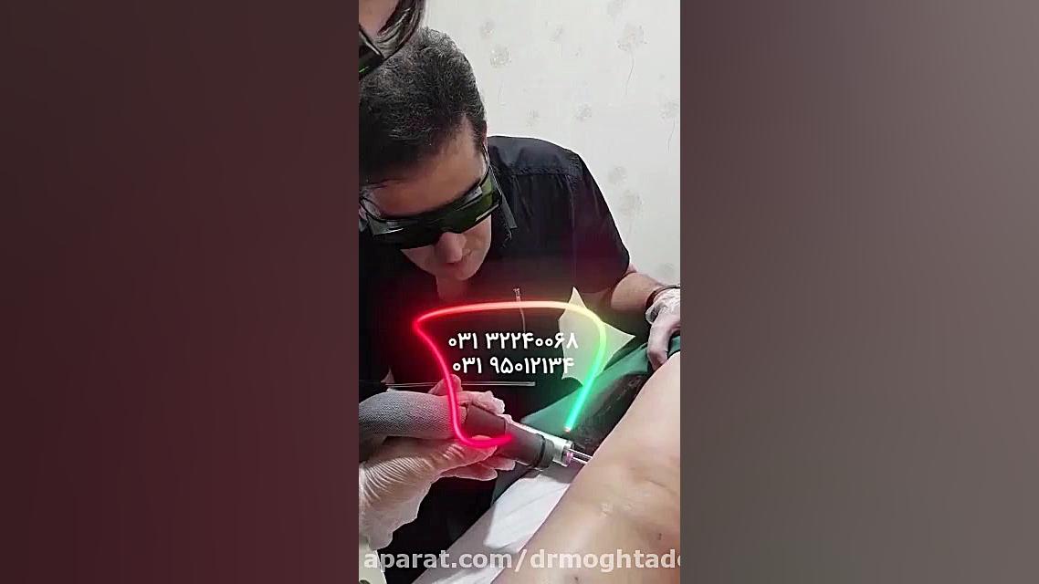 لیزر رگهای واریسی و تلانژکتازی دکتر علیرضا مقتدری | متخصص طب فیزیکی