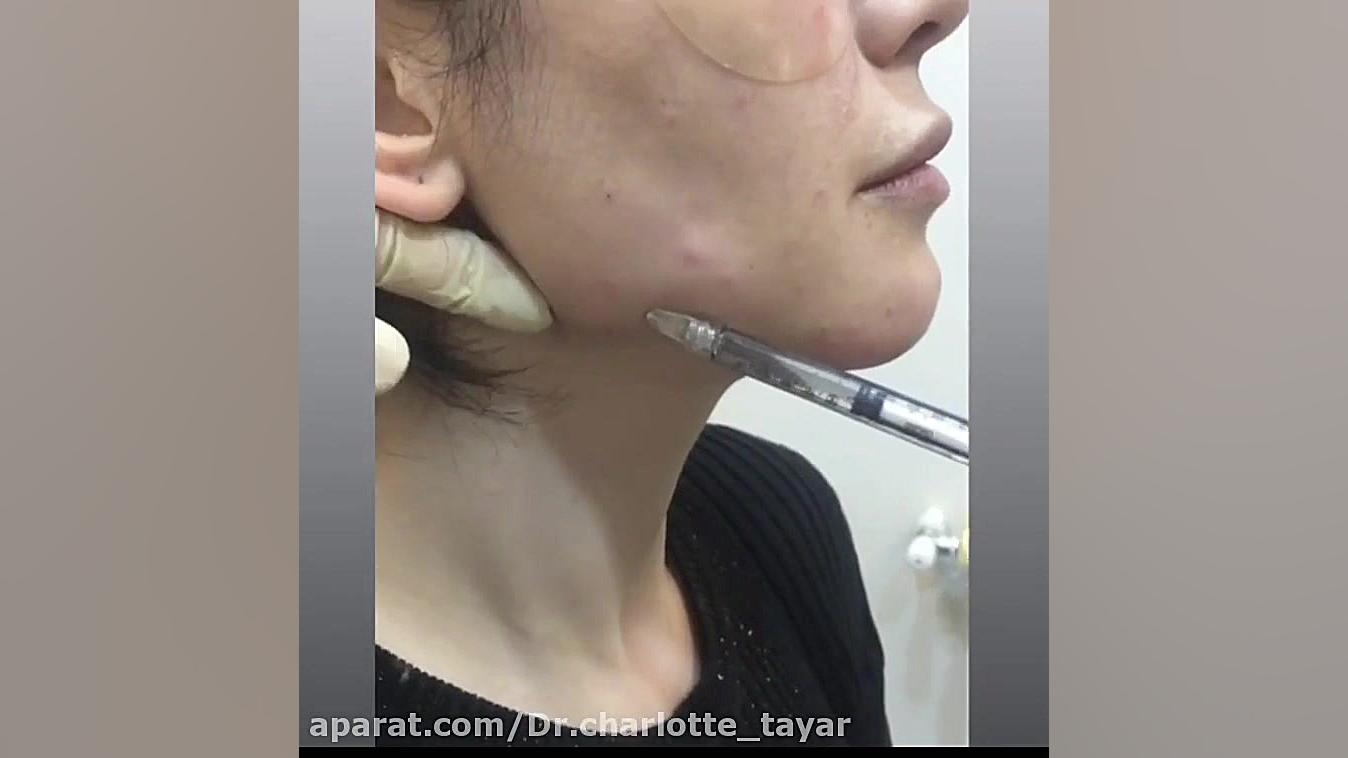 زاویه سازی صورت با تزریق ژل ترلتینیب