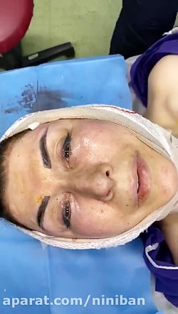 جراحی زیبایی صورت، بعد از عمل