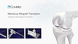 Meniscus Allograft Transplant
