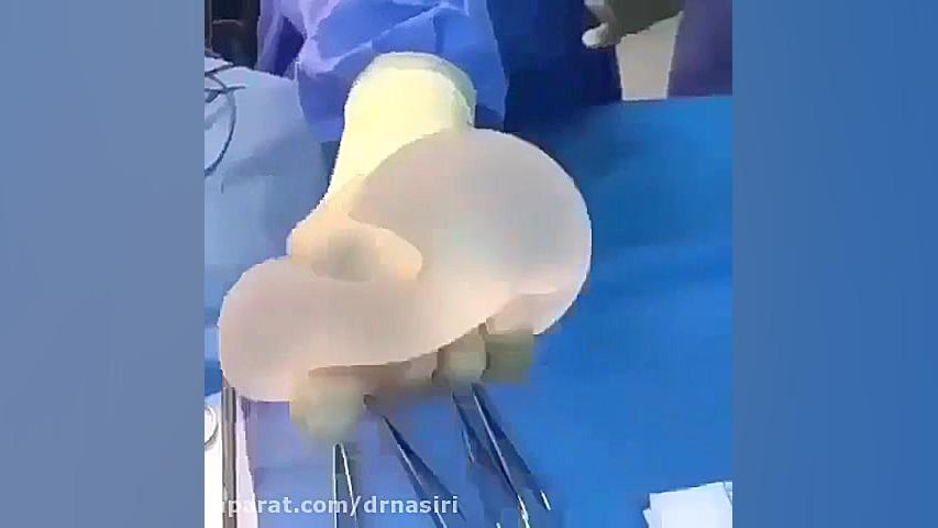 پارگی پروتز سینه دکتر احمدرضا نصیری