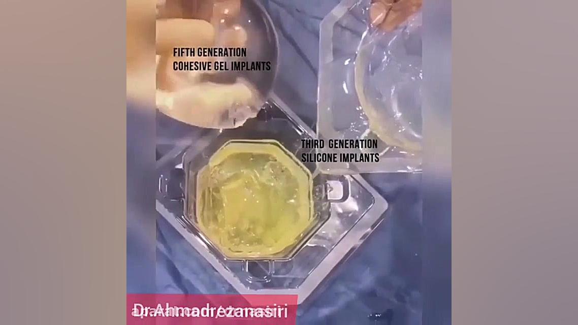 مقایسه پروتز سینه دکتر احمدرضا نصیری