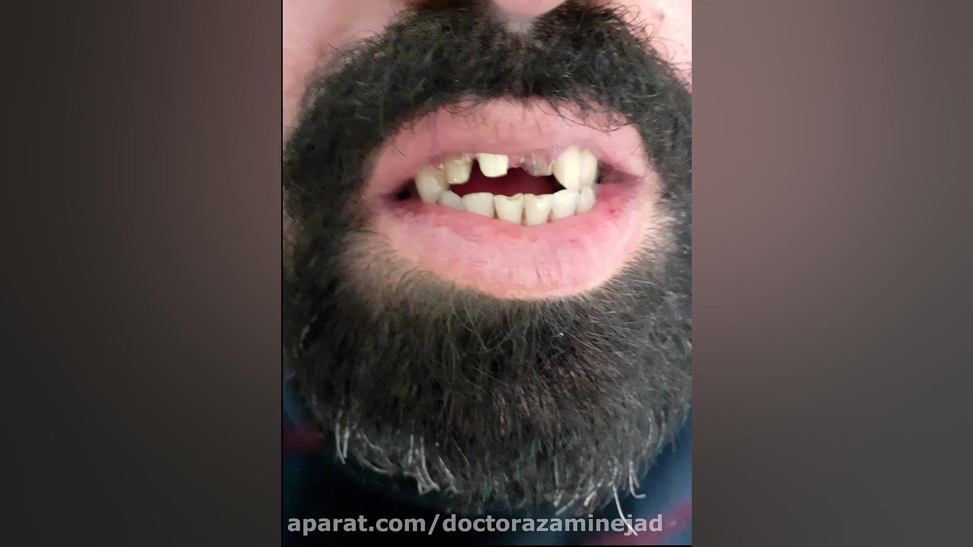 سه واحد روکش دندان ترمیم سوختگی