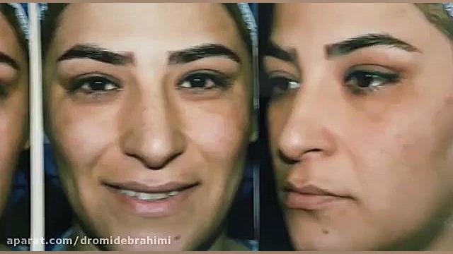 جراحی انحراف بینی توسط بهترین جراح بینی دکتر امید ابراهیمی دکتر امید ابراهیمی