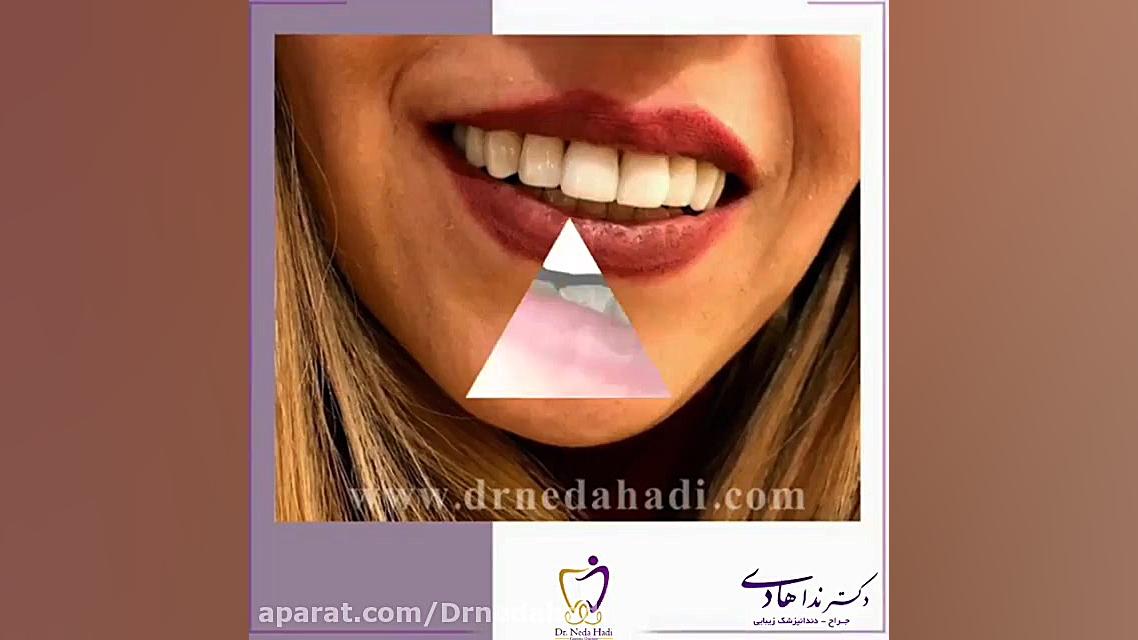 فیلم لمینت کامپوزیتی دکتر ندا هادی-دندانپزشک زیبایی