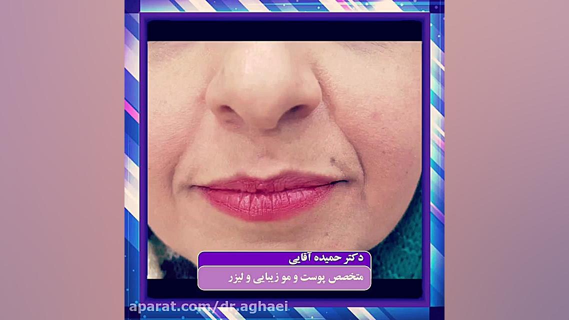 تزریق ژل خنده دکتر حمیده آقایی