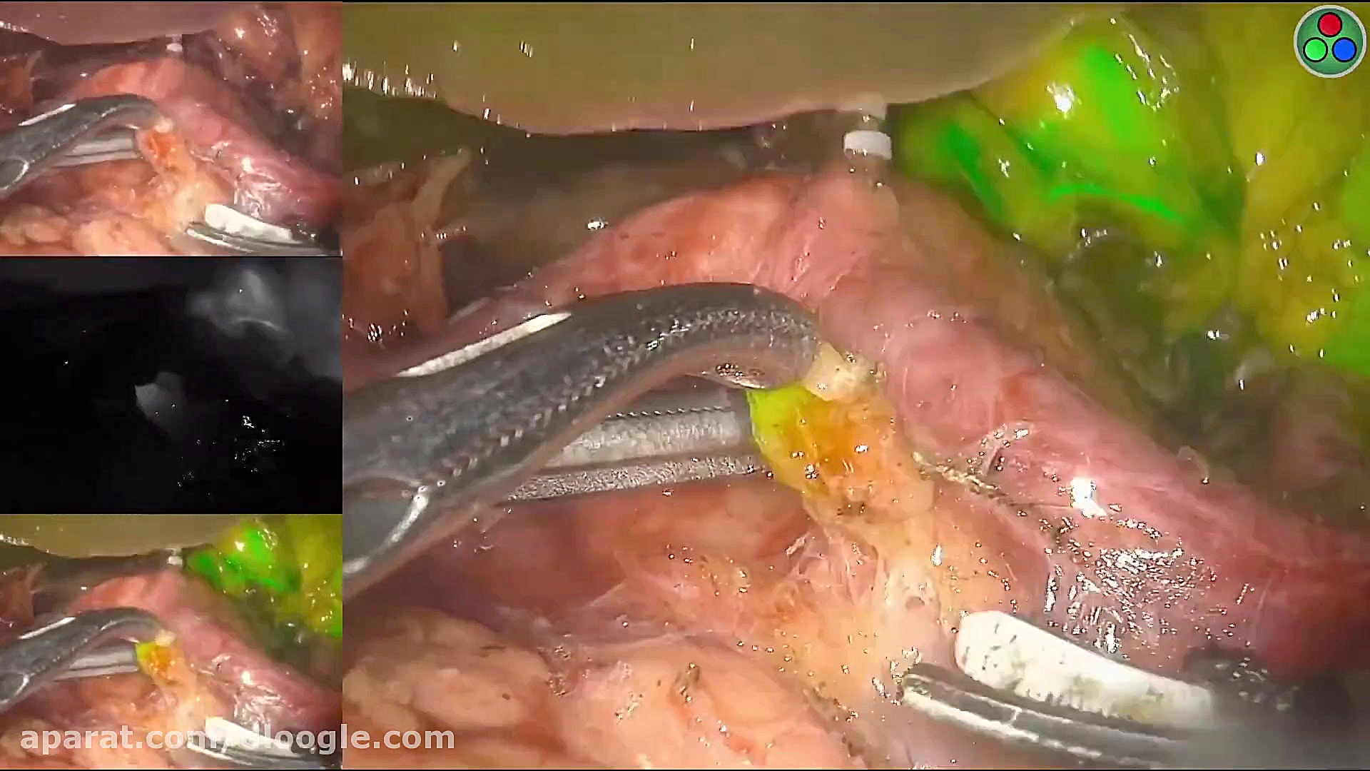 سرطان غدد لنفاوی دندانپزشک زیبایی