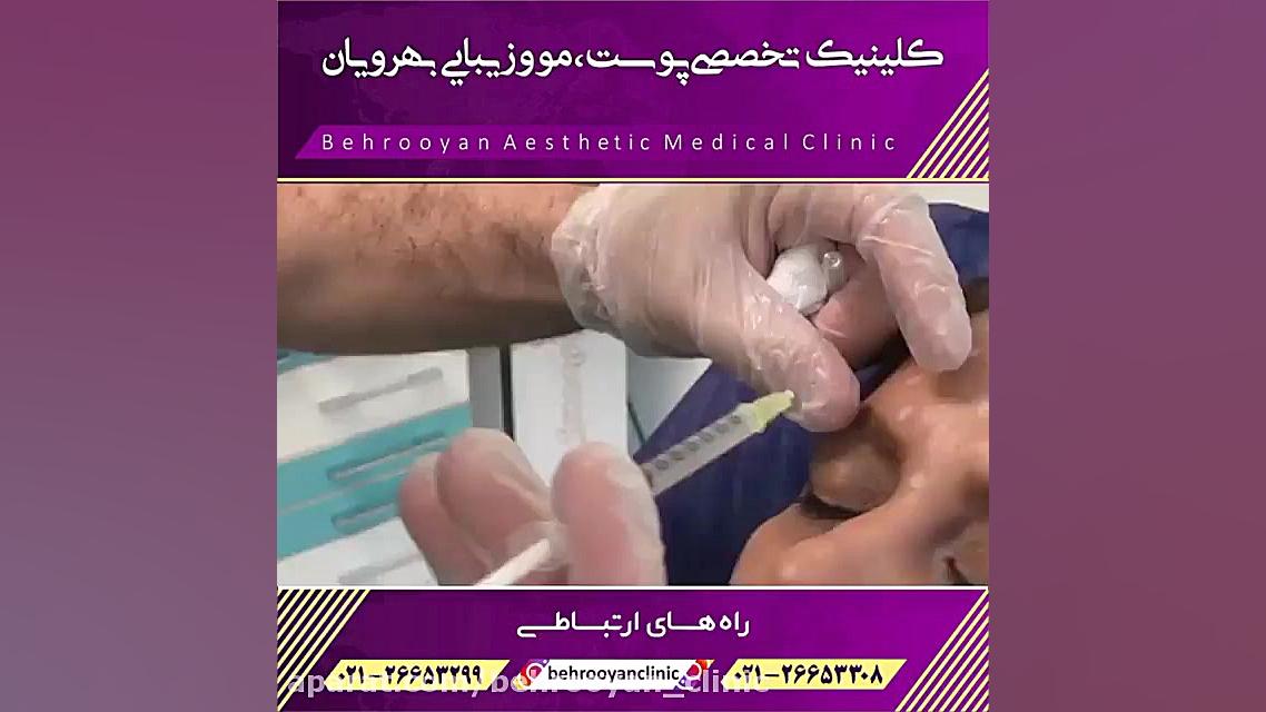 تزریق بوتاکس ، مصپورت یا دیسپورت ؟ رفع افتادگی پلک