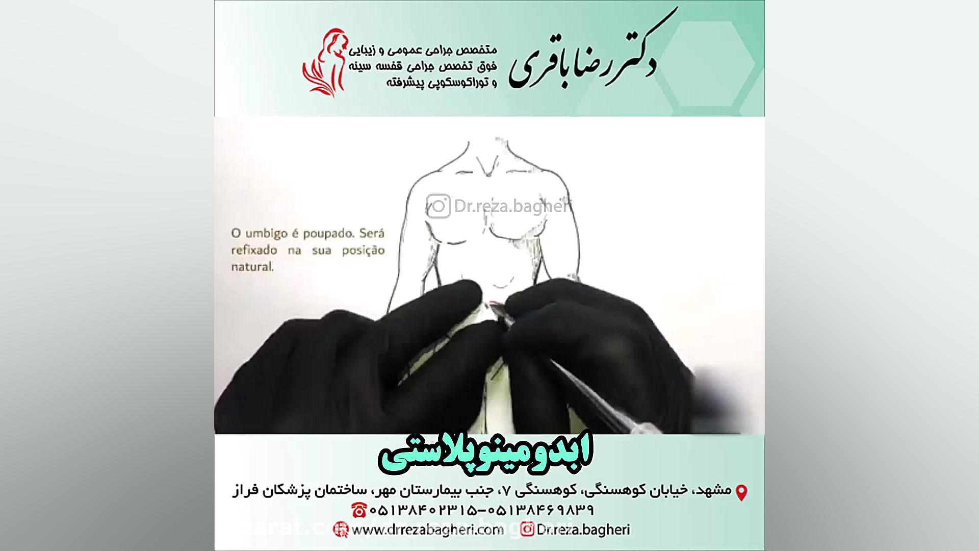 ابدومینوپلاستی دکتر رضا باقری جراح سینه در مشهد