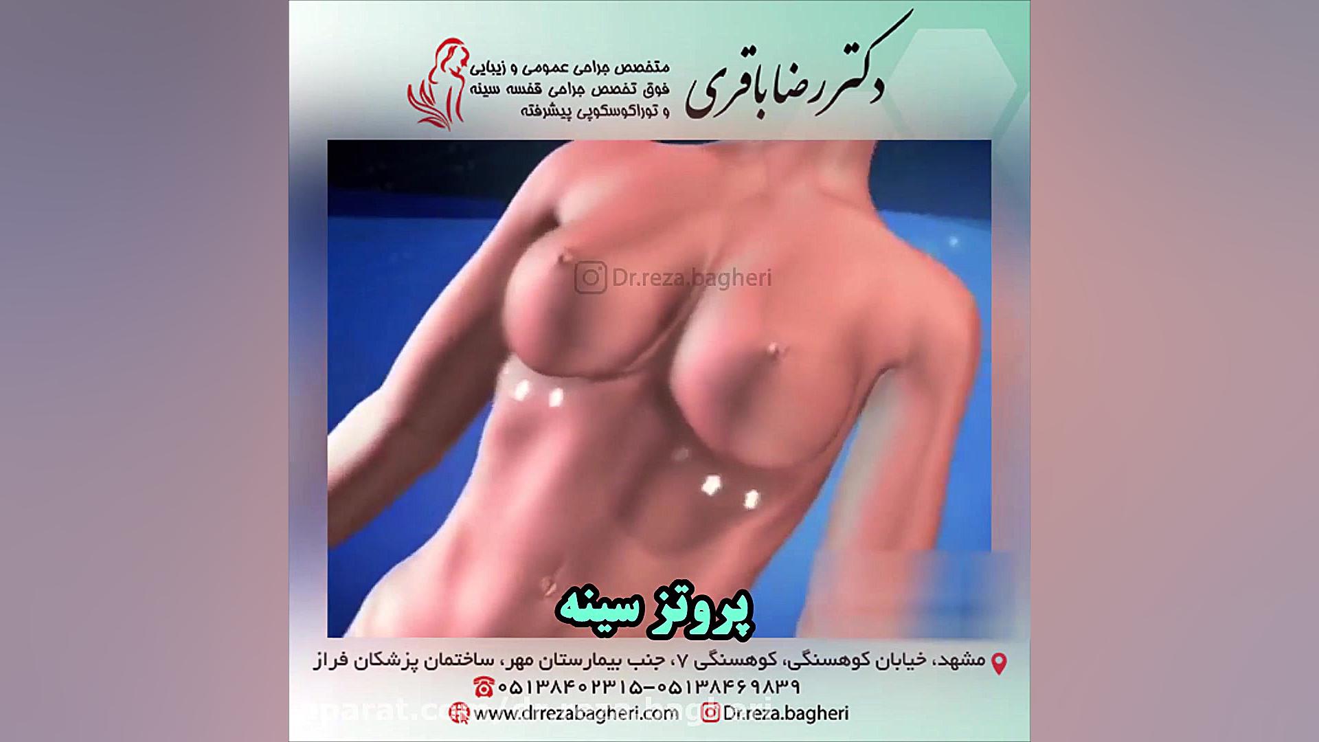 پروتز سینه دکتر رضا باقری جراح سینه در مشهد