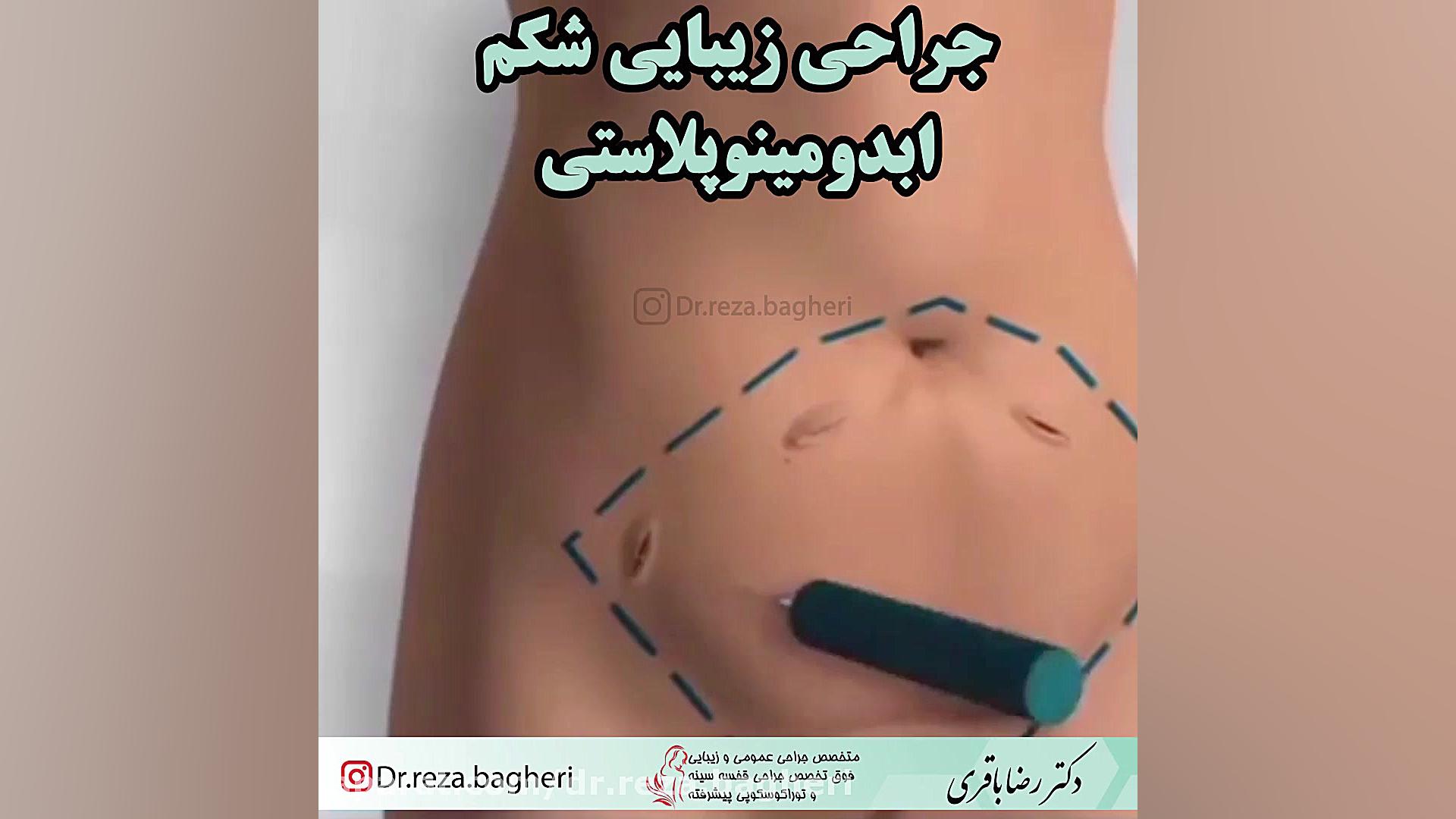 جراحی زیبایی شکم دکتر رضا باقری جراح سینه در مشهد
