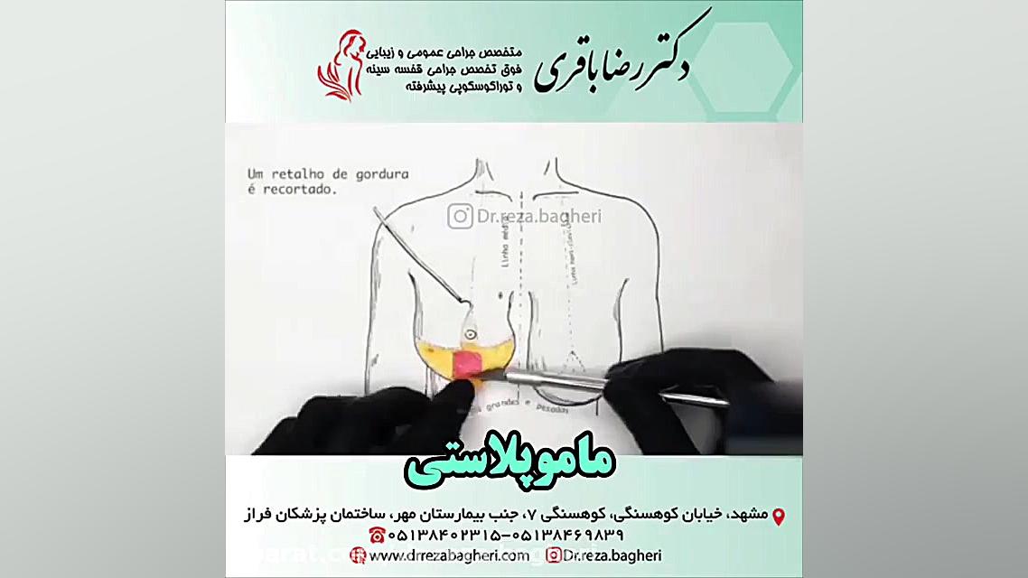 ماموپلاستی V/Q Scan
