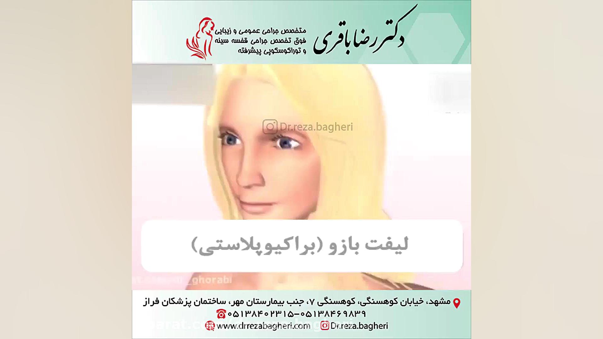 لیفت بازو دکتر رضا باقری جراح سینه در مشهد