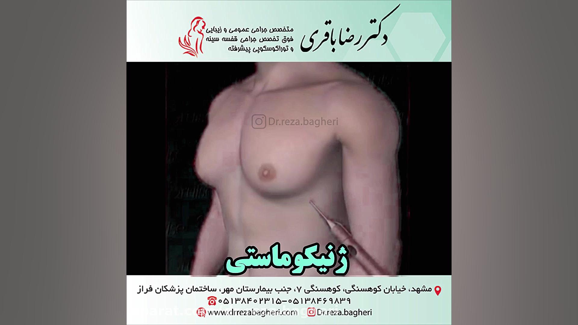 ژنیکوماستی دکتر رضا باقری جراح سینه در مشهد