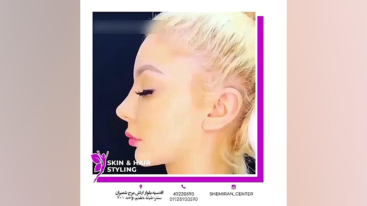 زاویه سازی و مادلینگ صورت با تزریق ژل ایربسارتان
