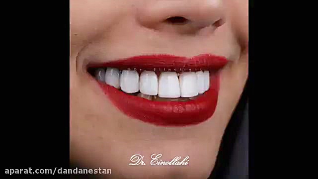 اصلاح طرح لبخند با استفاده از کامپوزیت ونیر | دندانستان علامت برودزینسکی