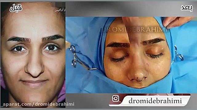 عمل انحراف بینی پهن توسط بهترین جراح بینی دکتر امید ابراهیمی دکتر امید ابراهیمی
