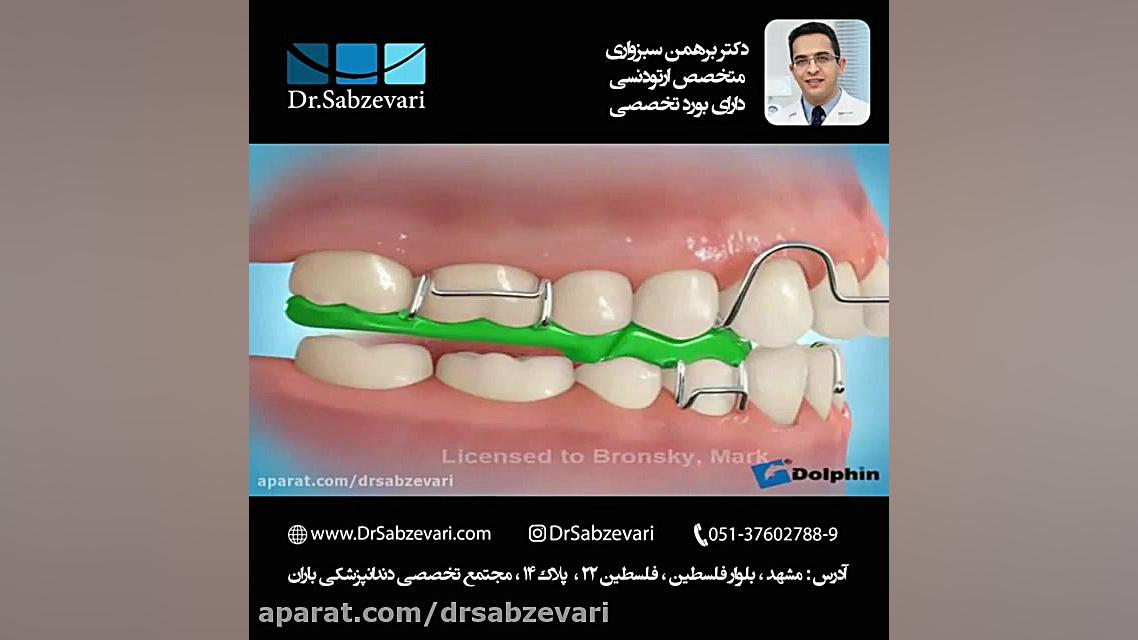 پلاک متحرک برای درمان کوچکی یا عقب بودن فک پایین دکتر برهمن سبزواری - متخصص ارتودنسی - مشهد