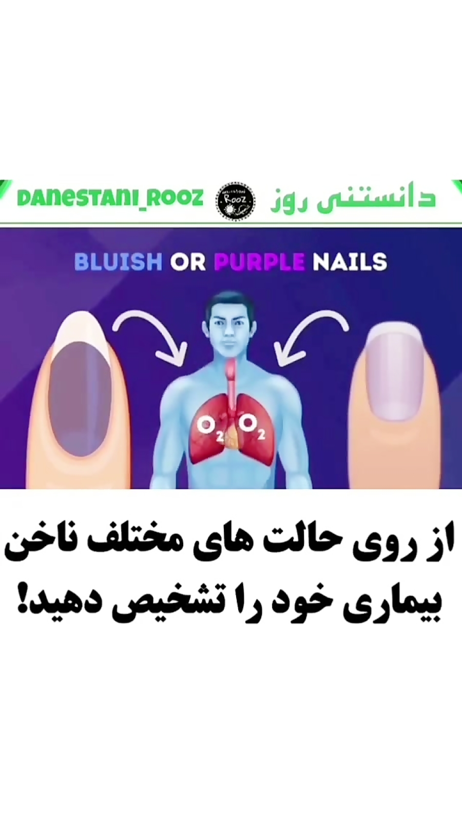 تشخیص بیماری از حالت ناخن ها