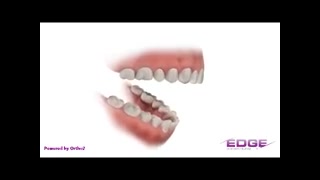 ارتودنسی با Herbst دکتر سهیل سالاری