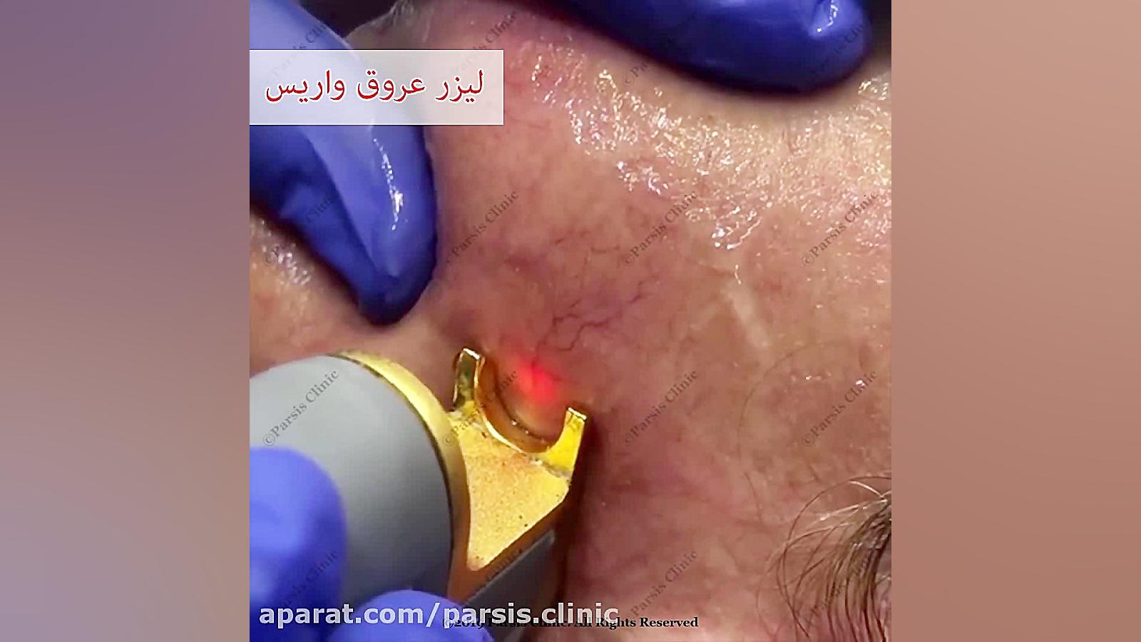 لیرز واریس و ضایعات عروقی کلینیک تخصصی پوست،زیبایی،لیزر و کاشت مو پارسیس