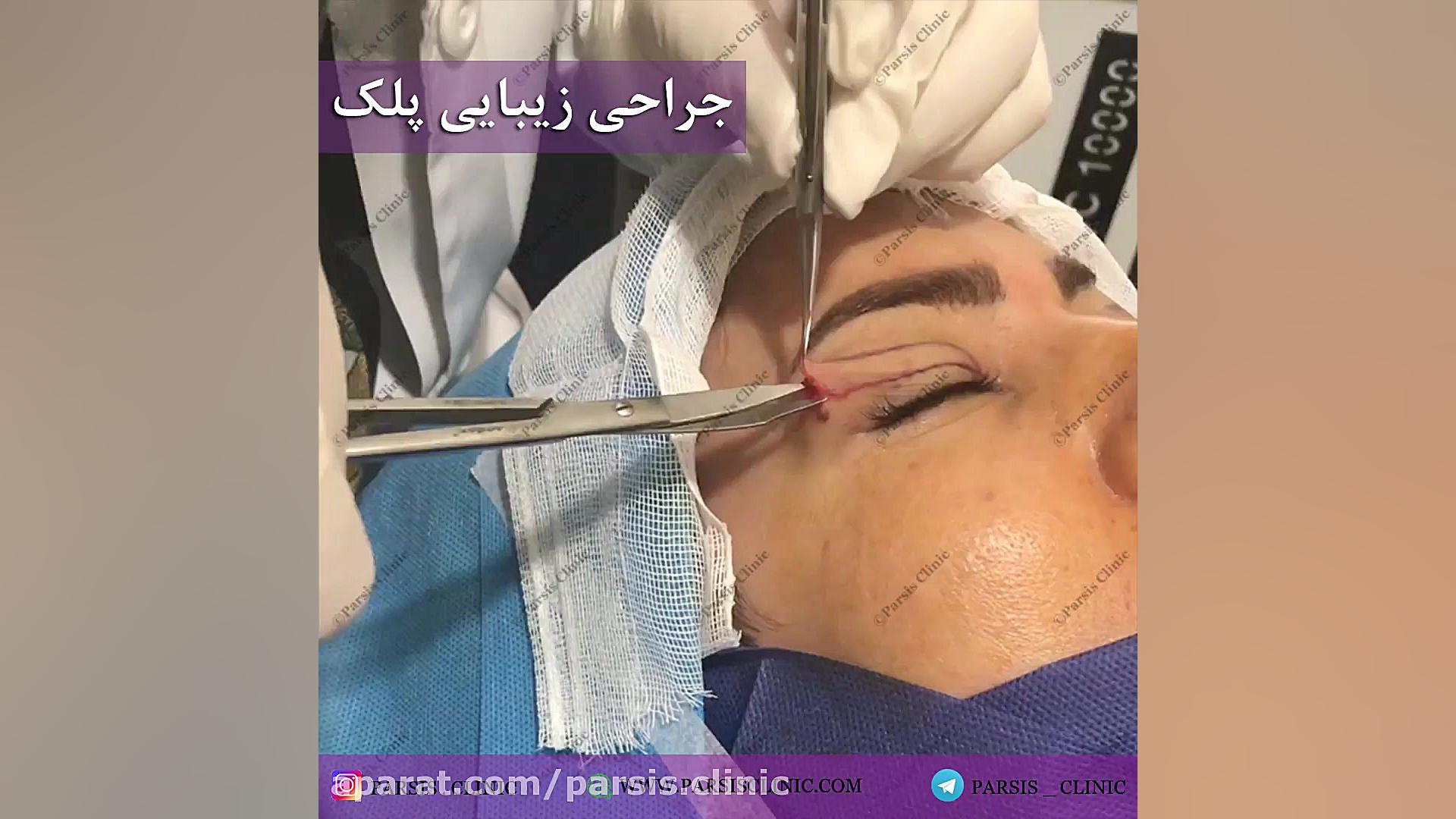 جراحی افتادگی پلک فوقانی کلینیک تخصصی پوست،زیبایی،لیزر و کاشت مو پارسیس