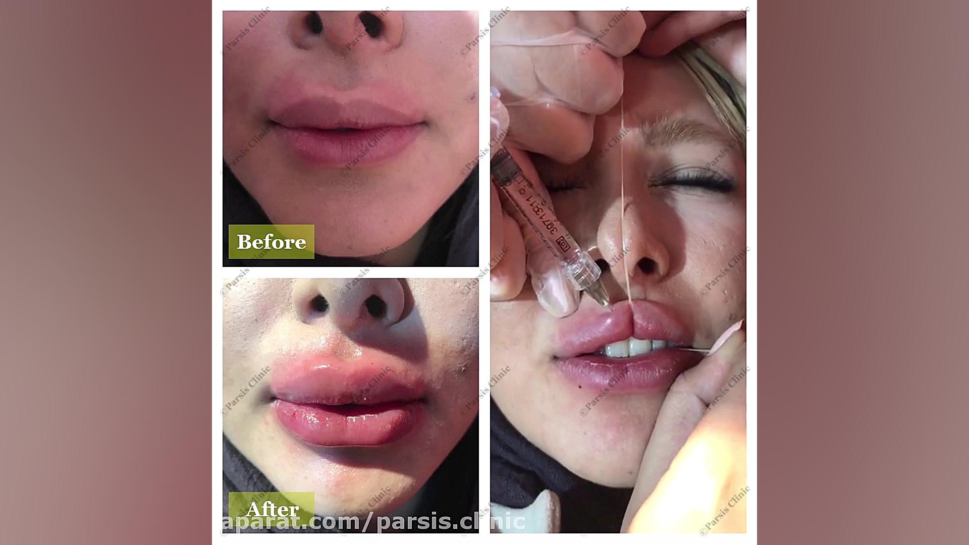 تزریق ژل لب و فرم دهی لب کلینیک تخصصی پوست،زیبایی،لیزر و کاشت مو پارسیس