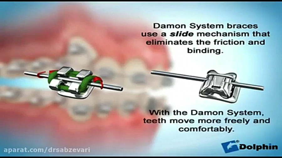 ارتودنسی ثابت دیمون (Damon) دکتر برهمن سبزواری - متخصص ارتودنسی - مشهد