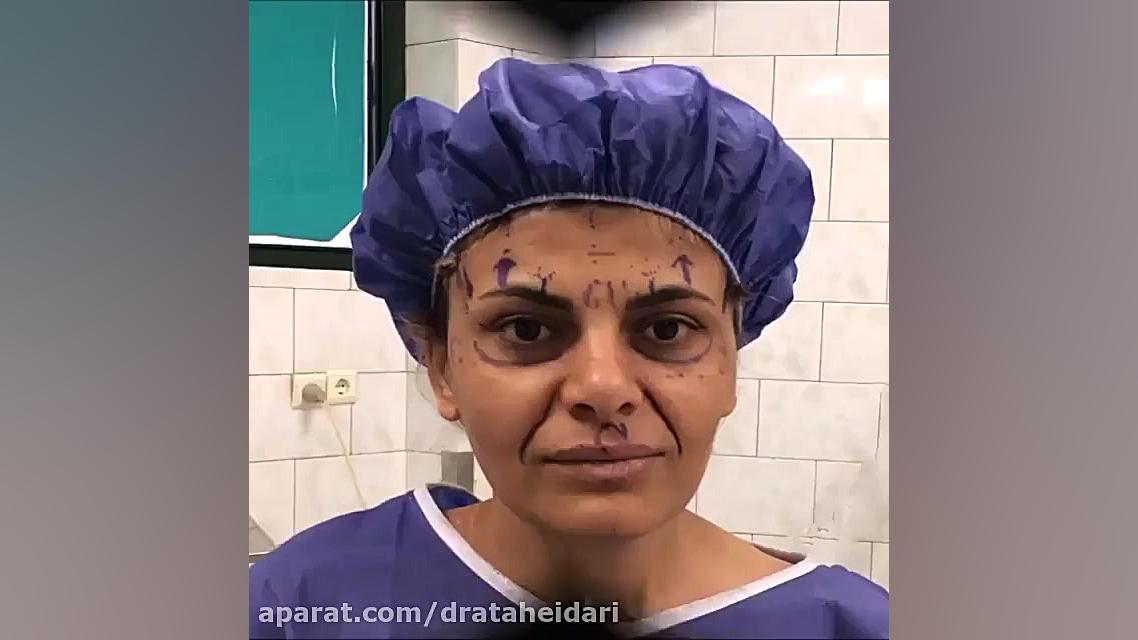 لیفت آندوسکوپی پیشانی دستگاه آنالیز اگزوزوم