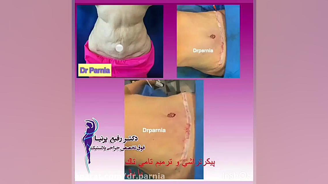 پیکرتراشی با دستگاه پال دکتر رفیع پرنیا فوق تخصص پلاستیک