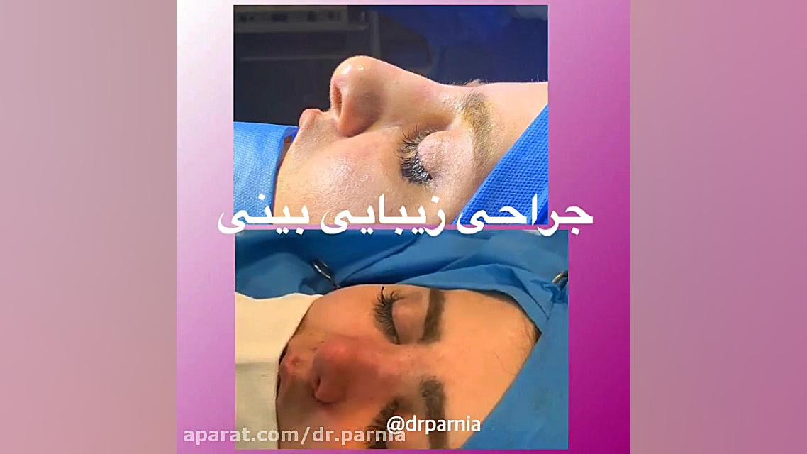 فیلم جراحی زیبایی بینی دکتر رفیع پرنیا فوق تخصص پلاستیک