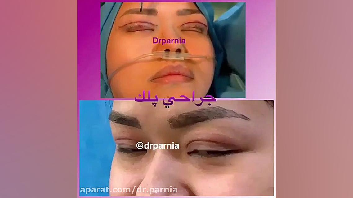 فیلم جراحی زیبایی چشم دکتر رفیع پرنیا فوق تخصص پلاستیک