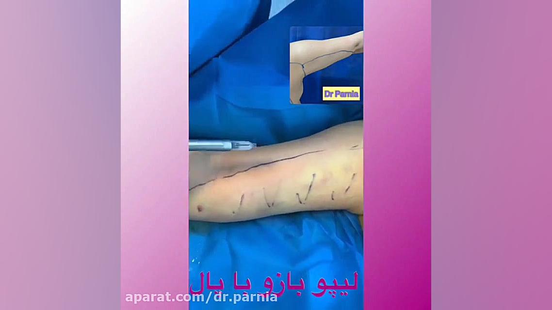 فیلم لیپوماتیک بازو با دستگاه پال دکتر رفیع پرنیا فوق تخصص پلاستیک