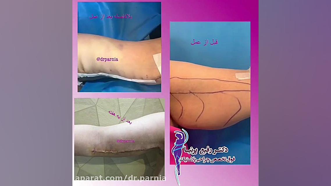 فیلم لیپوماتیک بازو دکتر رفیع پرنیا فوق تخصص پلاستیک