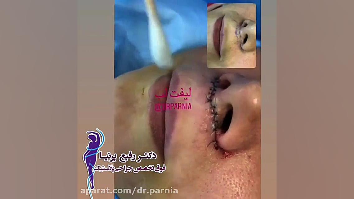 فیلم لیفت لب دکتر رفیع پرنیا فوق تخصص پلاستیک