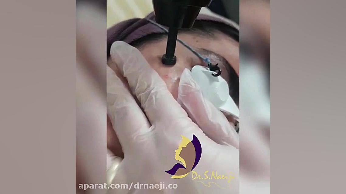فیلم برداشتن خال دکتر صدیقه نائیجی | متخصص پوست و مو در قم