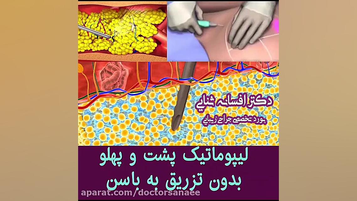 فیلم لیپوماتیک شکم و پهلو دکتر پوست