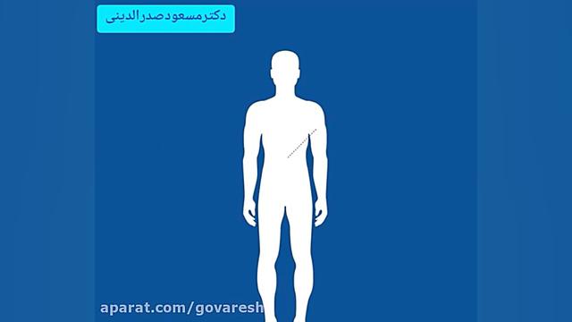 زخم معده چیست و از علائم آن چه می دانید ؟ لیپوساکشن