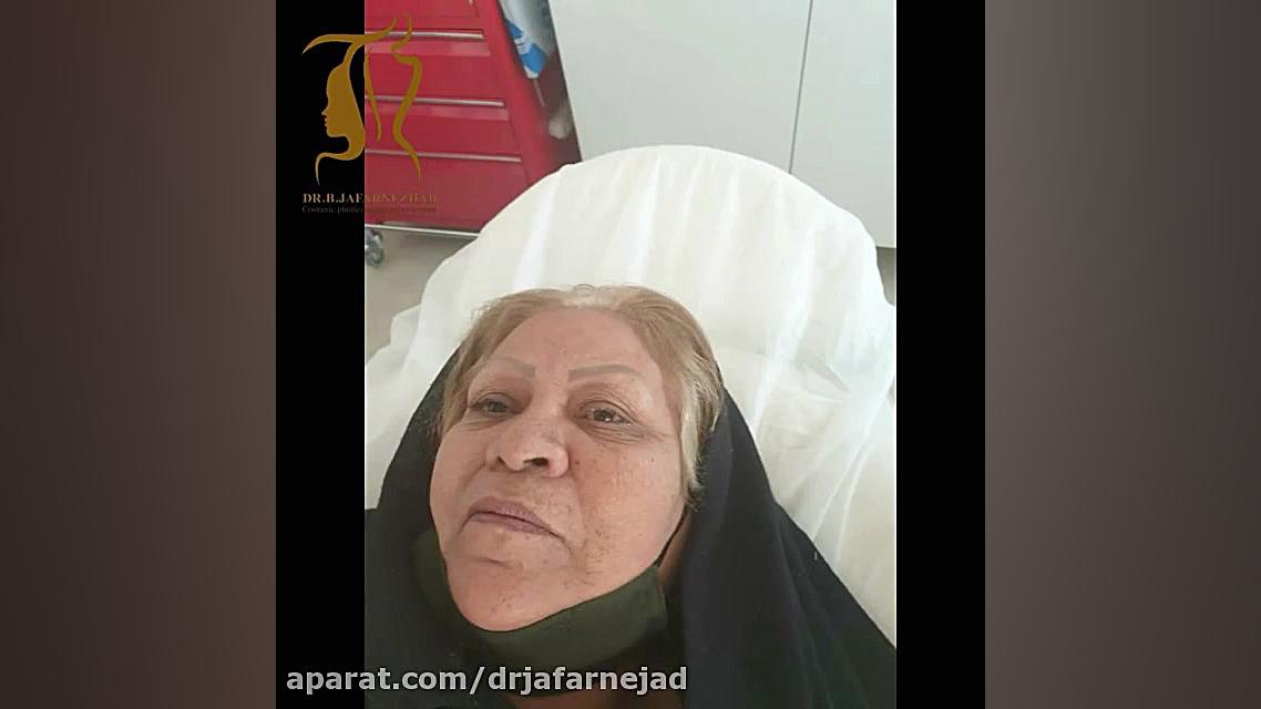 بلفاروپلاستی دکتر بابک جعفرنژاد