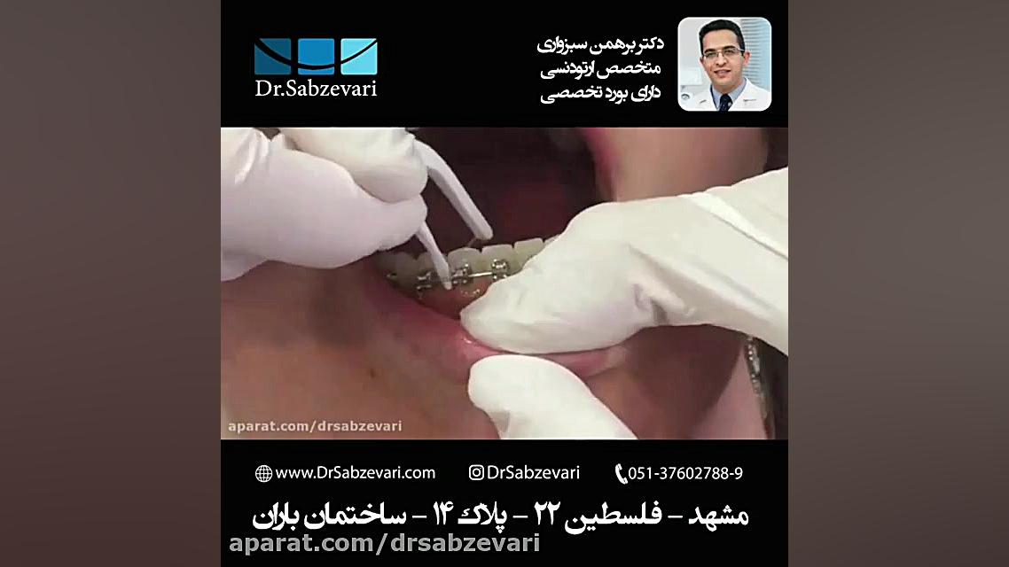 نخ دندان مخصوص در ارتودنسی ثابت دکتر برهمن سبزواری - متخصص ارتودنسی - مشهد
