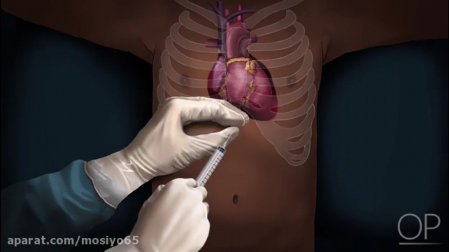 تکنیک آسپيراسيون ساده با سوزن حین CPR ( پریکاردیوسنتز) پریودنتیکس