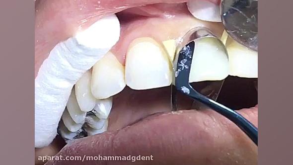 کامپوزیت ونیر دندانهای قدامی قسمت اول ( دکتر قربانیان ) گلوسودینیا
